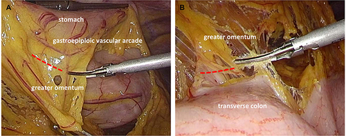 Figure 2 PO and TO in laparoscopic distal gastrectomy for gastric cancer. (A) PO, the greater omentum is dissected 3 cm away from the gastroepiploic vascular arcade and the residual greater omentum on the side of the transverse colon is preserved; (B) TO, the gastrocolic ligament is dissected from the transverse colon along the avascular plane.