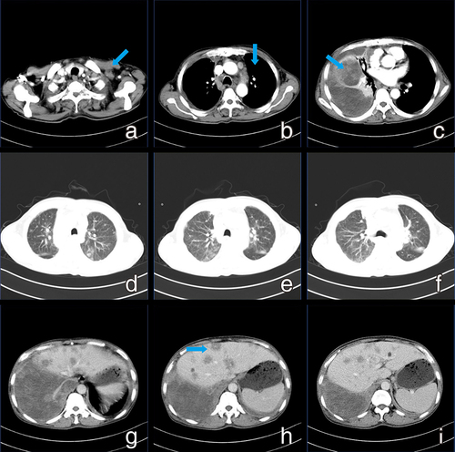 Figure 1 (a) enlarged supraclavicular lymph nodes (blue arrows); (b) enlarged lymph nodes in the hilar and mediastinal diaphragm groups (blue arrows); (c) Multiple wall nodules in the right pleura and right pleural encapsulated effusion, right pleural encapsulated effusion and restrictive expansion insufficiency in the middle and lower lobes of the right lung (blue arrows); (d–f) multiple nodules in both lungs with infection; (g–i) multiple slightly hypodense nodules in the liver (blue arrows).
