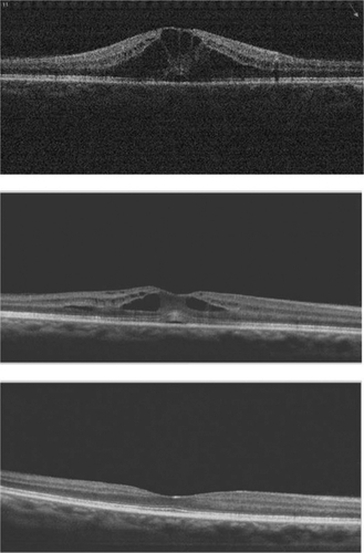 Figure 2 Spectral domain OCT macular images showing the evolution of cystoid macular edema, gradually improving and completely recovering after four weeks (lower picture) of medical treatment.