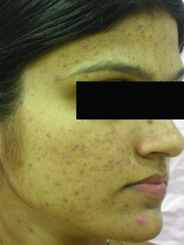 Figure 1 Post-acne scars and pigmentation before glycolic acid peel.
