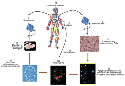 Figure 1 Proposal clinical application of immune therapy to treat MPM with dendritic cells loaded with autologous apoptotic tumor cells. The cancer cells can be treated in vivo and in vitro with either chemotherapeutic/immunogenic drugs or infected with the Measles virus vaccine. Part I to III could be proposed before the conventional treatment of the Patient, and part V to X after the treatment, when clinical efficacy is noticed.