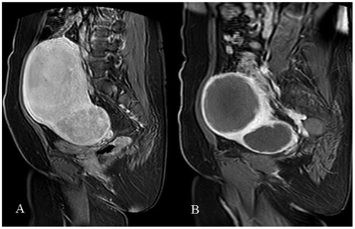 Figure 2. (A) Presents contrast-enhanced MRI of the fibroid prior to UFE. (B) Presents the same fibroid after UFE with almost complete fibroid infarction (90–99%) and residual contrast enhancement below 10%. Note small irregularity on the base of embolized fibroid. Category 2.