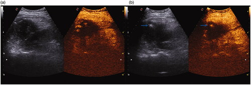 Figure 1. Contrast-enhanced ultrasound-guided radiofrequency ablation. (a) Contrast-enhanced ultrasound showed some residual viable hepatocellular carcinomas in the arterial phase with high enhancement after transcatheter arterial chemoembolization. (b) The blue arrow represents the radiofrequency ablation needle.