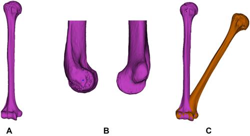 Figure 1 Using customized software (Mimics 14.01 software, Materialise, Leuven, Belgium), 3-D models of the affected and contralateral normal humeri were constructed (A). On the affected humerus and the mirror image of the contralateral normal humerus, the centers of the capitellum and trochlea were obtained with the use of a circle-fit algorithm at the lateral surface of the capitellum, and the center (flexion-extension) axis was created as a line through the geometric centers of the trochlea and capitellum (B). Then, the distal part of the model of the affected humerus was superimposed onto the corresponding part of the mirror image of the normal humerus to measure the degrees of varus and extension components of the deformity by point and surface registration using the medial and lateral epicondyles, the distal articular surface, and the flexion-extension axis as references (C).