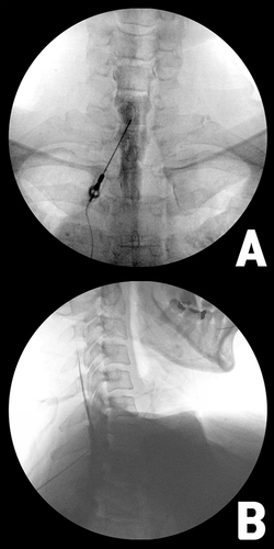 Figure 3 Antero-posterior view (A) and oblique view (B) of C-arm fluoroscopic image of confirmation of needle tip. Note radiopaque area dispersing widely following epidural anatomy.