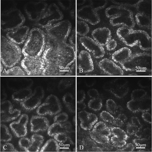 Figure 3. The MG figure under confocal microscopy from a 66-year-old female MGD patient before and after three simple IPL treatments. Enlarged acinar diameter was decreased and AUD was increased after treatment. A, B: before treatment. C, D: after three simple IPL treatments.