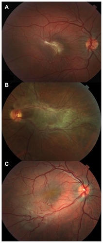 Figure 1 (A) Photograph of the fundus of the right eye in an 18-year-old girl who complained of metamorphopsia and reduced visual acuity, which was due to retinal folding corresponding to the epiretinal membrane underlying CHR-RPE in the macula. (B) Photograph during preoperative fundus examination of a 52-year-old man affected by CHR-RPE, showing a slight elevation on the optic disc and macula, retinal vessel tortuosity, hyperpigmentation, and extensive epiretinal membrane. (C) Photograph of preoperative peripheral CHR-RPE with epiretinal membrane in a 33-year-old man, showing retinal vessel tortuosity and visual distortion.
