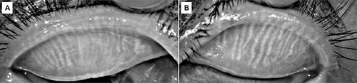 Figure 2 Meibography examination revealed grade 1 meibomian gland loss on superior eyelid of (A) right eye and (B) left eye.