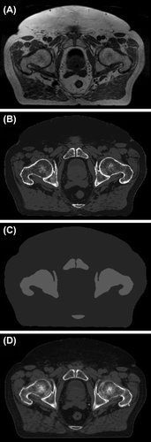 Figure 1. Example transversal slices of 3D reference images for IGRT with CBCT localization; a T1/T2*-weighted in-phase MR image (A), a heterogeneous pseudo-CT that was constructed from the MR image by the dual model HU conversion technique (B), a bulk pseudo-CT (C), and a standard CT (D). Contrast in the images is not comparable (different windowing properties and scaling).