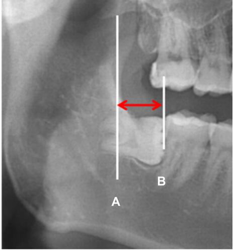 Figure 2 MSM trailing edge gap (red double arrow). (A): anterior edge line of mandibular ramus; (B): MSM trailing edge line.