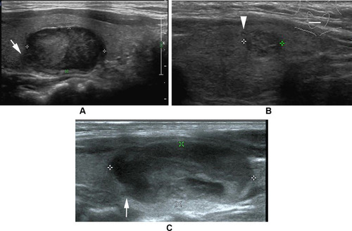 Figure 4 (A) Follicular thyroid carcinoma of the right thyroid in a 40-year-old male. Longitudinal sonogram indicates a generally oval nodule but with a lobulated change in the part of margin (arrow). (B) Follicular thyroid carcinoma of the right thyroid in a 40-year-old female. Transverse sonogram indicates a nodule with a spiculated change in the part of margin, deriving from tumor penetration of capsule (arrowhead). (C) Follicular thyroid carcinoma of the left thyroid in a 11-year-old female. Longitudinal sonogram shows a generally oval nodule but with a jagged change in the part of margin (arrow).