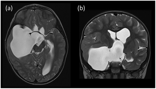 Figure 1. Pre-operative MRI. (a) Axial and (b) coronal T2-weighted images showing the large right sided arachnoid cyst with suprasellar and right middle cranial fossa components.