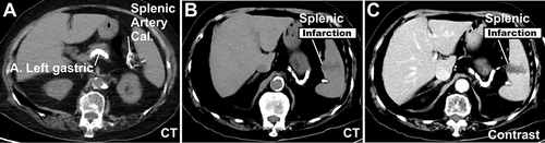 Figure 4 Several high-density calcifications in the splenic arteries (A–C), and a wedge-shaped region of low density within the spleen (B and C) were observed on an abdominal CT.