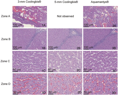 Figure 7. Histological findings from the in vivo coagulation zones created with the 3-mm Coolingbis® (1(A–D)), 5-mm Coolingbis® (2(A–D)) and Aquamantys® (3)A–D)) devices in spot mode.