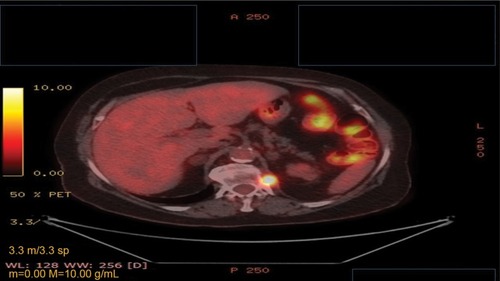 Figure 5 Positron emission tomography–computed tomography with the disease relapse lesion under the diaphragm 1.2 cm.