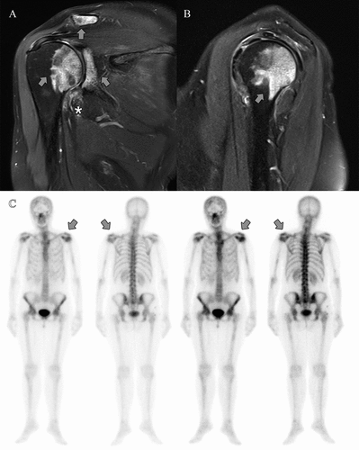 Figure 1. (A, B) Coronal and sagittal T2-weighted magnetic resonance imaging (MRI) of the left shoulder and (C) bone scintigraphy of a 61-year-old female presenting with a 9 month history of frozen shoulder. (A, B) MRI demonstrates bone marrow hypersignal of the humeral head with extension to the glenoid cavity and acromioclavicular region (arrow), as well as thickening and hyperintensity of the inferior glenohumeral ligament. (C) Bone scintigraphy shows early increased radiotracer uptake in the left glenohumeral region and later in other locations.