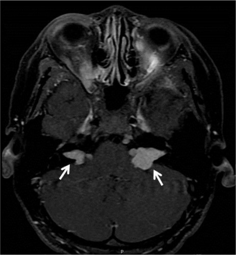 Figure 5 Bilateral vestibular schwannomas (white arrows) at bilateral cerebellopontine angle extending to bilateral expanded internal acoustic canal (case 1).