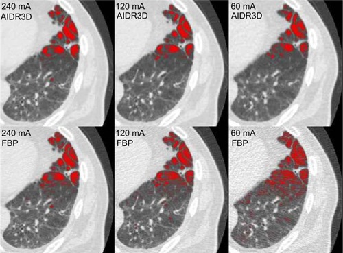 Figure 1 Example of emphysema measurements made by the workstation used in this study.Notes: Low attenuation areas (LAA, < −950 HU) are shown as red-colored areas. For this case (81 year old male, 62 kg), when using AIDR3D, measured LAA% results were 6.8% at 240 mA, 7.7% at 120 mA, and 8.0% at 60 mA. When not using AIDR3D (ie, when using FBP), LAA% results were 9.2% at 240 mA, 12.0% at 120 mA, and 15.3% at 60 mA. Note that LAA% measurements were obtained automatically for the entire lung and not from these single axial images.Abbreviations: LAA%, percent low attenuation area; AIDR3D, Adaptive Iterative Dose Reduction using Three Dimensional Processing; FBP, filtered-back projection; HU, Hounsfield unit.