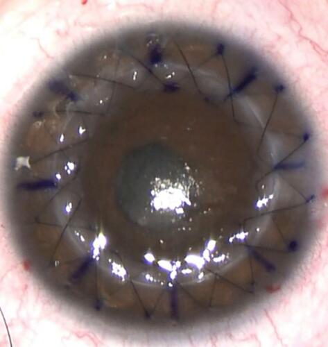 Figure 3 A young surgeon’s first independent continuous cross-stitch keratoplasty in a patient using the Homburg cross-stitch marker. The two sutures are crossing almost everywhere over the interface.Citation8
