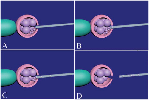 Figure 2. Fragment and debris removal from a cleavage-stage embryo. Firstly, the zona pellucida should be opened by assisted hatching. The embryo is held by the holding pipette and noncontact 1.48 diode laser is used to open the zona pellucida (A). The place of assisted hatching should be precisely selected near the fragments and debris. After opening of the zona pellucida, an appropriate micropipette (10–12 µm) is inserted between blastomeres space (B) and the fragments and debris around the blastomeres are gently removed (C). During fragment and debris removal, continued refocusing should be performed for easy access to fragments and debris. Finally, the micropipette is gently removed and the embryo is released from the holding pipette (D).
