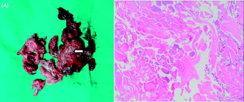 Figure 5. Placental implantation lesions and pathological findings. (A) Retained placenta accreta tissue showed tissue degeneration (HIFU); (B) Tissue degeneration and infarction under the microscope (HE × 200).