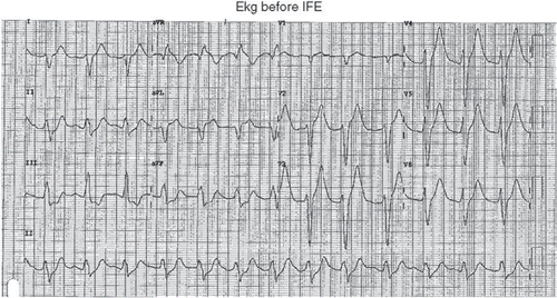 Fig. 1. EKG illustrating evidence of sodium channel blockade.