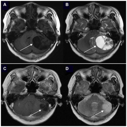 Figure 1 The brain enhanced MRI of a 61-year-old woman with non-small cell lung cancer and EGFR 21L858R mutation before and after EGFR-TKI treatment. The positions indicated by the arrows are the lesions. (A) Contrast-enhanced T1-weighted MR image at baseline. (B) Contrast-enhanced T2-weighted MR image at baseline. (C) Contrast-enhanced T1-weighted MR image after icotinib (first-generation EGFR-TKI) treatment and whole brain radiotherapy (prescription dose and fraction schedule of 30Gy/10F) treatment for 1 month. (D) Contrast-enhanced T2-weighted MR image after icotinib and whole brain radiotherapy treatment for 1 month.