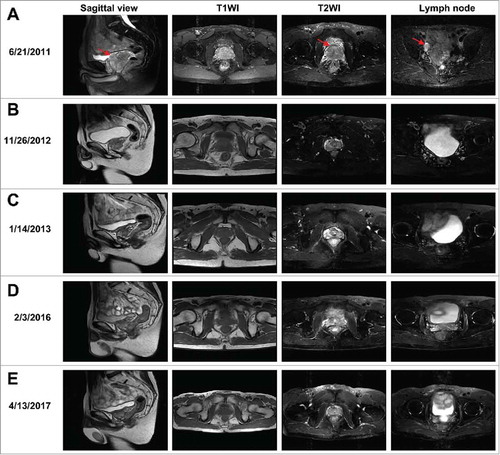 Figure 1. MRI scans of the patient before and after treatment for prostate cancer. (A–E) T1-weighted image (T1WI) and T2-weighted image (T2WI), as well as the sagittal view and lymph node images from T2WI from June 21, 2011 to April 13, 2017. Red arrows indicate the tumor in the prostate and lymph node metastasis.