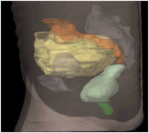 Figure 1. Organs at risk in lateral view: dark green: anal-sphincter; light green: rectum; orange: sigmoid; yellow: small intestines.