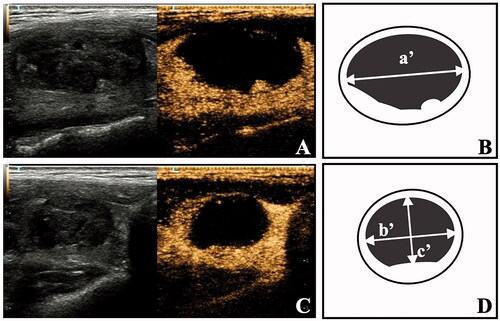 Figure 2. The measurement of ablated volume (Va) on CEUS images after RFA. (A, C) The longitudinal and transverse CEUS images showed Va present as a nonenhanced zone during arterial phase and venous phase. (B, D) Diagrams showed the measurement method of Va by CEUS.