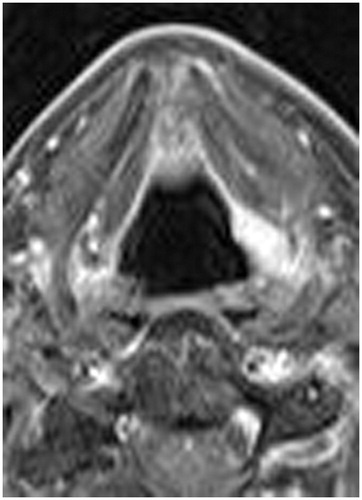 Figure 3. Post-operative MRI showing the location of the lesion in the left aryepiglottic fold.