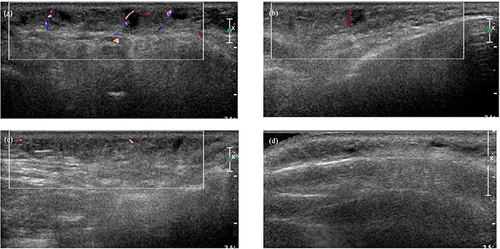 Figure 2 Echo-color Doppler (ECD) images of the patient 4 months after the mesotherapy. (a) ECD images of the left side of the face. Inhomogeneous hypoechoic nodules with distinct borders and irregular shapes were detected in the subcutaneous layer (the biggest was 5*7*6mm), with increased vascularity and enhanced echogenicity of the fat layer. (b and c) An ECD image of the right side of the face. The echogenic enhancement and increased blood flow signal were detected in the fat layer, with fewer hypoechoic nodules compared to the left side. (d) An ECD image of the forehead. Several hypoechoic nodules with distinct borders and irregular shapes were detected in the subcutaneous layer. The echogenicity of the peripheral fat layer was enhanced.