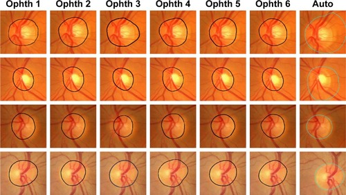 Figure 6 Examples of bad disc segmentation results for both TIFF (MESSIDOR and Magrabi) and JPG (Bin Rushed) images comparing with those of six ophthalmologists.