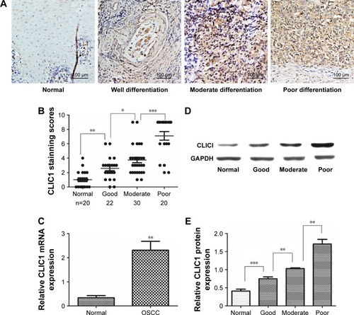 Figure 1 CLIC1 expression was significantly increased in oral squamous cell carcinoma (OSCC) tissue.