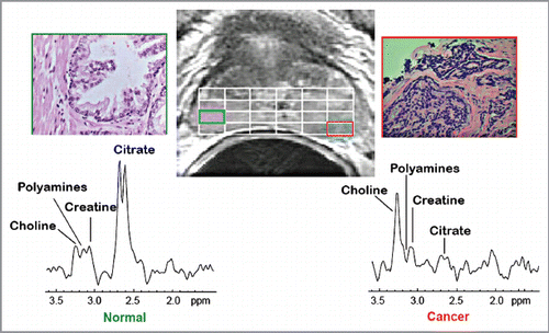 Figure 2 In vivo 3T 1H MRSI spectra taken from a region of normal peripheral zone and spectra taken from a region of prostate cancer and corresponding H&E stained sections identified on the corresponding T2 weighted MR image (center). 1H MRSI provides arrays of contiguous 1H MR spectra from throughout the prostate (white grid overlaid on MR image) and the spectra were selected to be localized within regions of healthy and cancerous tissues based on concordance of step-section histology of the resected prostate and T2 weighted MRI. Citrate is dramatically reduced in the Gleason 4+4 cancer as compared with healthy peripheral zone.