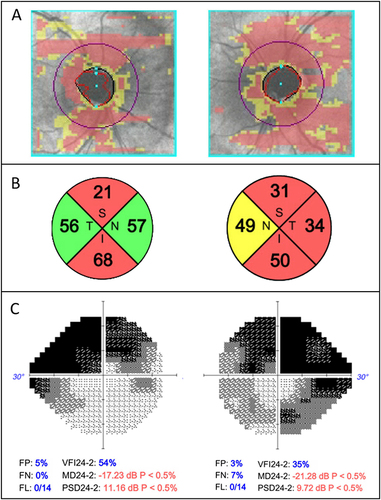 Figure 2 Optical Coherence Tomography and Humphrey Visual Field findings of a patient who developed severe glaucoma in the setting of prolonged steroid response following dropless cataract surgery. (A) Cirrus retinal nerve fiber layer (RNFL) Deviation Map for both eyes showing optic disc cupping and thinning of the peripapillary RNFL in both eyes. (B) RNFL thickness by quadrant showing superior and inferior thinning in the right eye and diffuse thinning in the left eye with mean RNFL thickness of 47 and 41 µm in the right and left eyes, respectively. (C) 24–2 SITA-Fast of right and left eyes showing significant arcuate defects in both eyes.