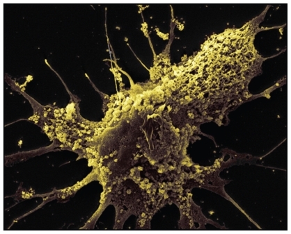 Figure 5 Exosomes are observed on the surface of glioblastoma cells. Tumor-specific peptides or antigens from TEX can be purified and pulsed onto dendritic cells for immunotherapy. Copyright © 2008, Nature Publishing Group. Reproduced with permission from Skog J, Wurdinger T, van Rijn S, et al. Glioblastoma microvesicles transport RNA and proteins that promote tumour growth and provide diagnostic biomarkers. Nat Cell Biol. 2008;10(12):1470–1476.