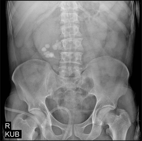 Figure 1 KUB showing several right renal stones.