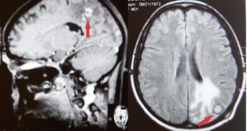 Figure 1 Contrasted brain MRI revealed enhanced masses in the occipital and parietal lobes (arrow).