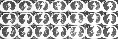 Figure 1 Chest CT (day-64, in (A)) revealed bilateral GGOs, predominantly in the left lower lobe. CT scans taken on day-70, day-79, day-85, day-92, and day-120 after COVID-19 onset (in B–F respectively) showed rapidly changing migratory pulmonary infiltrates consistent with organizing pneumonia. In (G) the CT scan showed the resolution of the pulmonary infiltrates on day-141. Supplementary note: A1, B1, C1, D1, E1, F1, and G1 are the chest CT at the bifurcation level of the trachea. A2, B2, C2, D2, E2, F2, and G2 are the chest CT at the level of right middle bronchus and left main bronchus. A3, B3, C3, D3, E3, F3, and G3 are the chest CT at the level of right middle bronchus.
