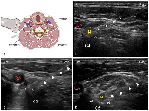 Figure 1 (A) Ultrasound-guided selective cervical nerve root block (UG-SCNRB). (B–D) Axial transverse ultrasound image depicting the sharp anterior tubercle (at) of the cervical vertebra transverse process. Solid arrowheads reveal the location of needle placement between the target nerve root and posterior tubercle. ((B) C4; (C) C5; (D) C6).