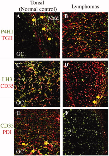 Figure 3. Comparison of three selected collagen modifying enzymes on transglutaminase II+ fibroblastic reticular cells or CD35+ follicular dendritic cells in between malignant lymphomas and postulated normal counterparts. Prolyl 4-hydroxylase 1 (P4H1) was expressed in the germinal center (GC) and marginal zone (MaZ) (A; FITC, green colored) and transglutaminase II+ fibroblastic reticular cells (TGII+ FRCs) were localized in the MaZ (A; rhodamine, red colored) in the tonsil. There were a few of P4H1+TGII+ FRCs in MaZ (A; merged, yellow colored and arrows). In nodular sclerosis classical Hodgkin lymphoma, P4H1+TGII+ FRCs were proliferating (B; merged, yellow colored) at the background of Hodgkin–Reed–Sternberg cells (data not shown). Lysyl hydroxylase 3 (LH3) was expressed in the GC (C; FITC, green colored) and CD35+ follicular dendritic cells (CD35+ FDCs) were localized in the GC (C; rhodamine, red colored) in the tonsil. There were a lot of LH3+CD35+ FDCs in GC (C; merged, yellow colored). In follicular lymphoma, there were a few of LH3+CD35+ FDCs in the neoplastic follicle (D; merged, yellow colored and arrows). Protein disulfide isomerase (PDI) was expressed in the GC (E; rhodamine, red colored) and CD35+ FDCs were localized in the GC (E; FITC, green colored) in the tonsil. PDI+CD35+ FDCs were scattered in GC (E; merged, yellow colored and arrows). In follicular lymphoma, no PDI+CD35+ FDCs was existed in the neoplastic follicle (E; FITC, green colored).