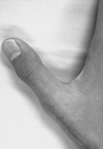 Figure 5.  At 6 weeks after the operation, the patient had full range of movement of his right thumb.