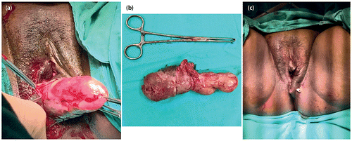 Figure 2: Intraoperative and postoperative pictures demonstrating removal of leiomyoma via vulvo-vaginal incision and closure with drainage of remaining dead space.