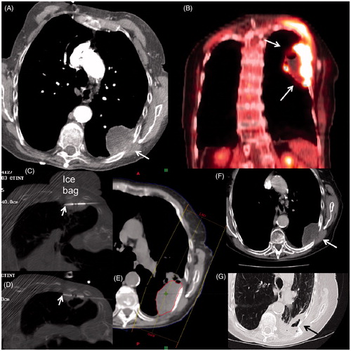 Figure 3. An 84-year-old woman with history of severe COPD from extensive cigarette smoking on oxygen therapy presented with severe left chest wall pain. (A) Axial CT scan shows a large necrotic mass with extension into chest wall (arrow) which was confirmed to be squamous cell carcinoma on subsequent biopsy. (B) Coronal image from staging FDG PET/CT shows extensive uptake with central necrosis without evidence of regional or distant spread (Stage 2B). Based on size and necrosis, a combination treatment with MWA and radiotherapy was planned. (C, D) Axial CT-fluoroscopic images show two antennas (arrows) placed superiorly and inferiorly within the mass close to the chest wall. Note the placement of the cold saline bag placed on the skin to reduce heating during the MWA. The patient’s pain was markedly relieved within 24 h of the MWA. (E) Image from subsequent radiation treatment plan targeting the mass. (F) Axial CT follow-up images at 6 months and (G) 2 years after treatment shows central necrosis (white arrow) and eventual shrinkage and cavitation (black arrow). The patient died of her respiratory disease, but not from her lung cancer.