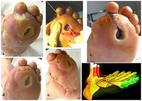 Figure 3 Clinical correspondence of the angiographic pattern showed in Figure 2. A neuroischemic plantar ulcer in an acute diabetic foot presentation: (a) Initial clinical aspect featuring a lateral plantar artery hypoperfusion and sole forefoot abscess. (b) and (c) Abscess drainage and debridement. (d) and (e) Clinical evolution at weeks 3 and 5.