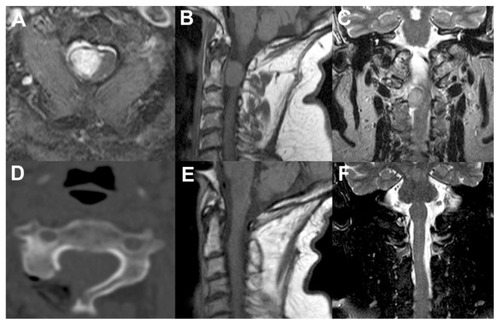 Figure 1 Illustrative case 1. (A–C) Preoperative axial, sagittal, and coronal magnetic resonance images showing a right upper cervical spine meningioma. (D) Postoperative computed tomography scan showing the unilateral approach. (E and F) Postoperative MRI demonstrating complete removal of the lesion.