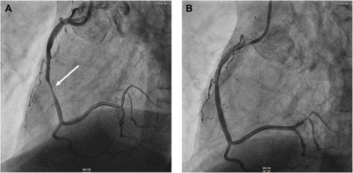 Figure 1 Coronary artery angiography of a 71-year old male with acute exacerbated COPD GOLD D and elevated plasma troponin.