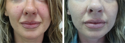 Figure 3 Before (left) and one month after (right) treatment of nasolabial folds with 1 mL of cross-linked CMC for each side.