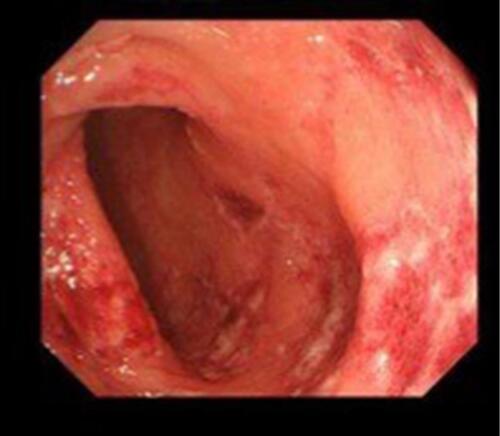 Figure 2 Endoscopic view of transverse colon mucosa showing diffuse redness, erosion, ulcer, and hemorrhage.